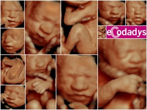 Diferentes fotos de una ecografía 5D de bebé de Ecodadys