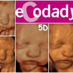 Comparación de ecografías 5D y 4D a las 29 semanas de Ecodadys